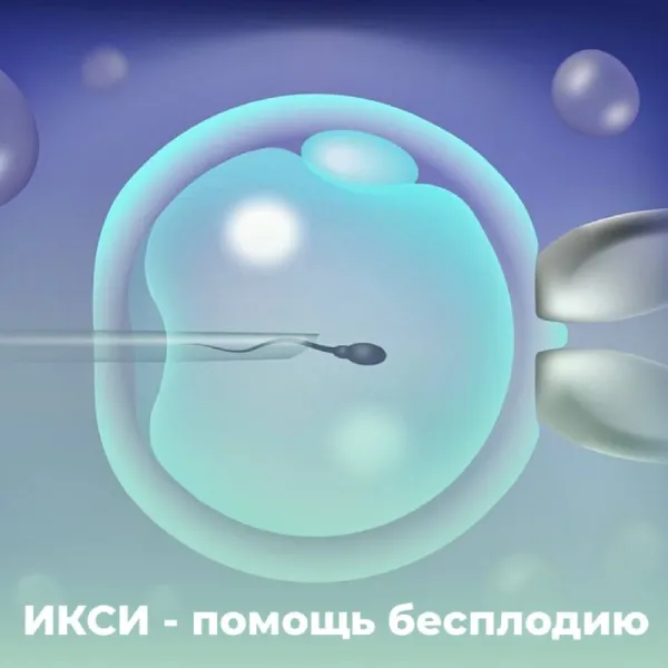 ИКСИ: метод оплодотворения при мужском бесплодии