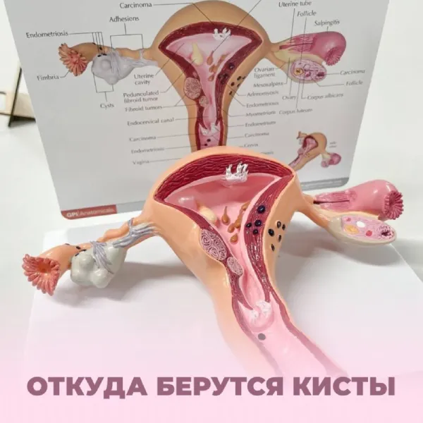 Откуда берутся кисты и как их лечить
